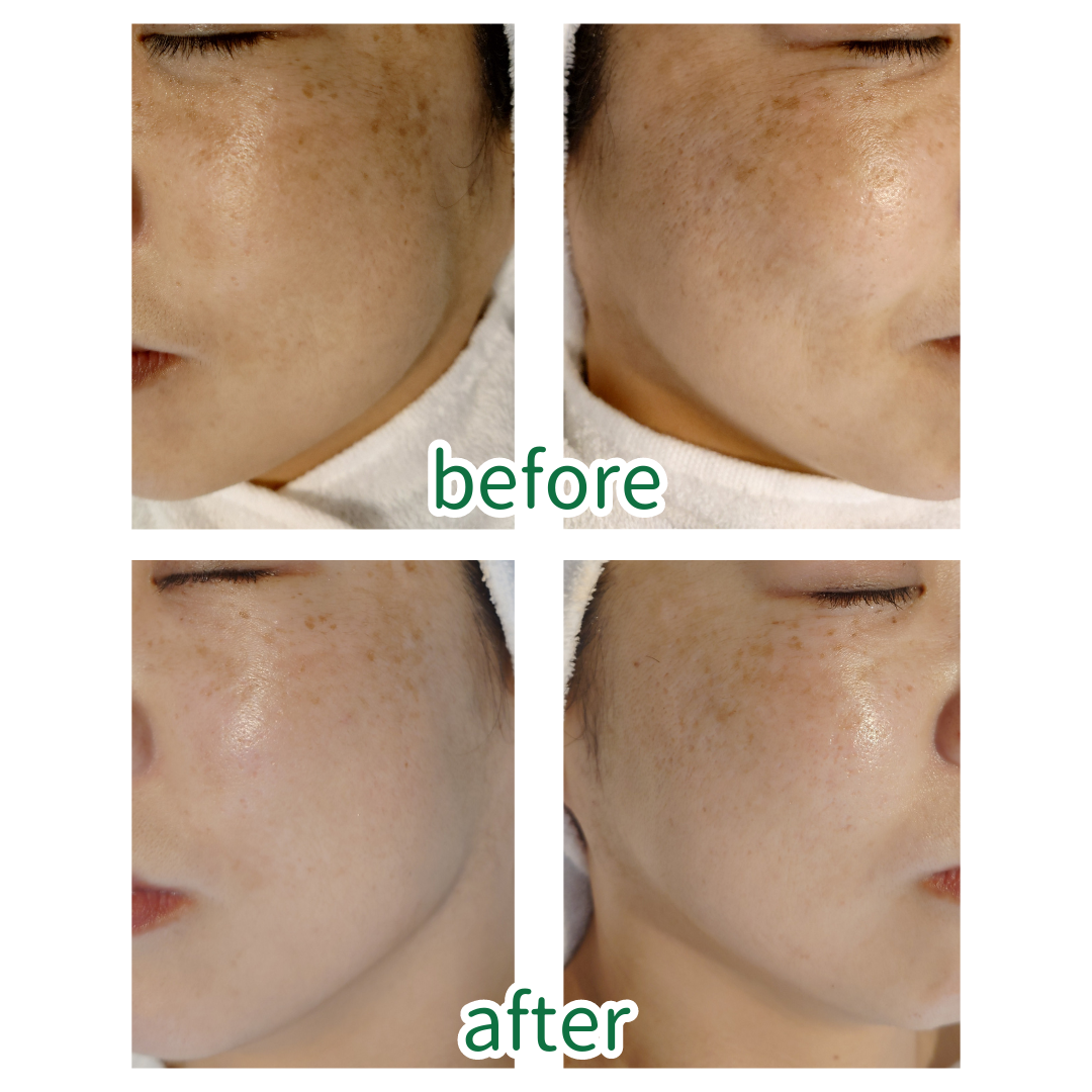 くすみのない透明感のある肌に!エンビロンとインディバ